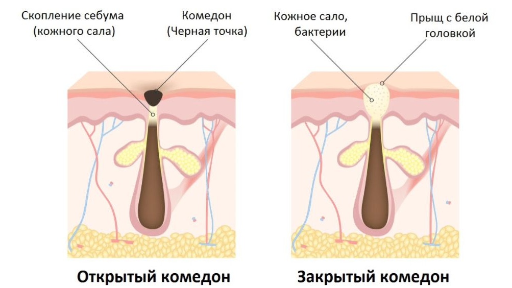 50 шт., полоски для удаления черных точек на носу